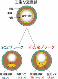 正常な冠動脈と安定プラーク・不安定プラーク