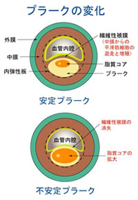 プラークの変化