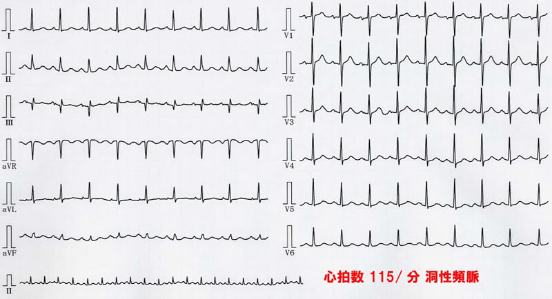 心電図：洞性頻脈