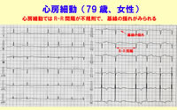 心房細動について