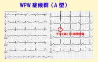 WPW症候群の心電図