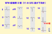 WPW症候群の心電図