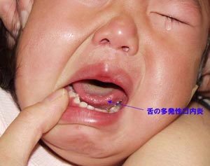 ヘルペス性(歯肉)口内炎-写真01 舌の口内炎