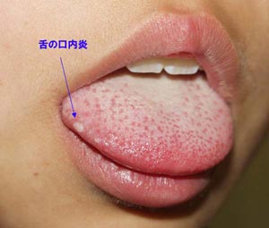 ヘルペス性(歯肉)口内炎-写真02 舌の口内炎