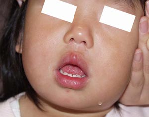 ヘルペス性(歯肉)口内炎-写真05 口唇の発赤・腫脹