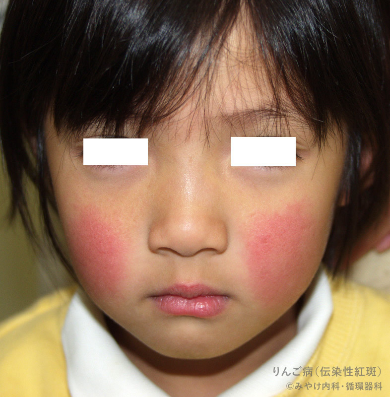 写真で見る子どもの病気：りんご病〈顔〉