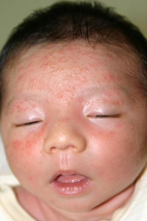 乳児湿疹と乳児脂漏性皮膚炎