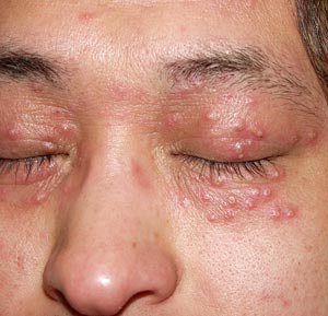 単純ヘルペス感染症-写真11