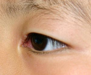 単純ヘルペス感染症-写真02