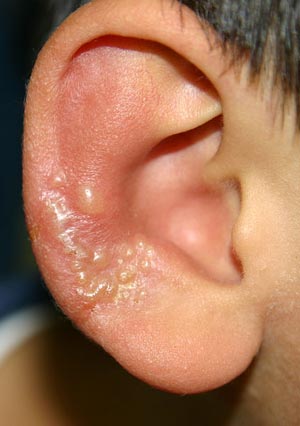 単純ヘルペス感染症-写真05