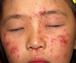 単純ヘルペス感染症-写真08