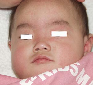 突発性発疹−写真5