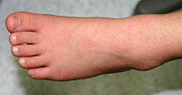 溶連菌感染症の手足の皮膚の変化