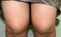 溶連菌感染症の手足の皮膚の変化