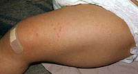 溶連菌感染症の手足の皮膚の変化