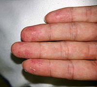 溶連菌感染症の手足の皮膚の変化