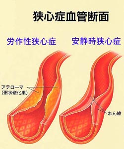 (イラスト1)狭心症血管断面