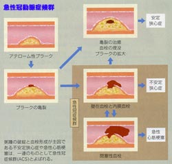 (イラスト2)急性冠動脈症候群