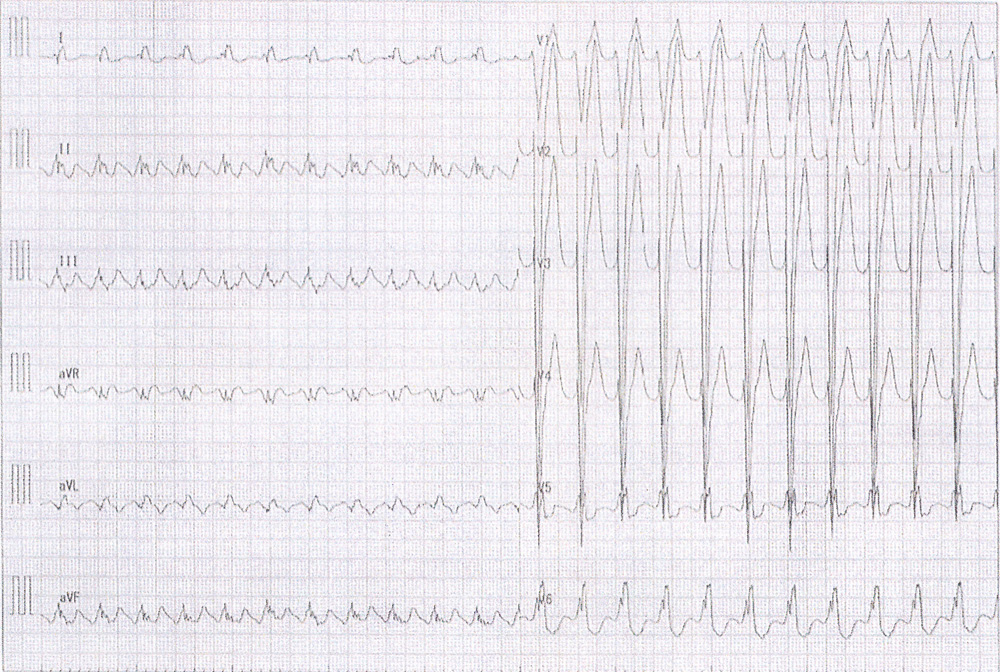 Wide QRS tachycardia