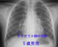 胸部レントゲン写真から考える肺疾患