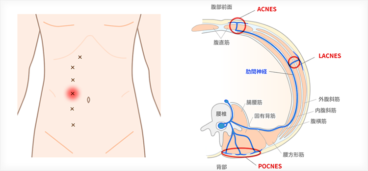 前皮神経絞扼症候群（ACNES）