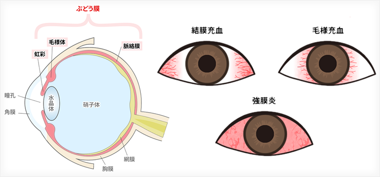 ぶどう膜炎と内科疾患