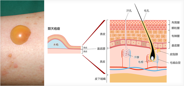 自己免疫性水疱症と口腔内びらん