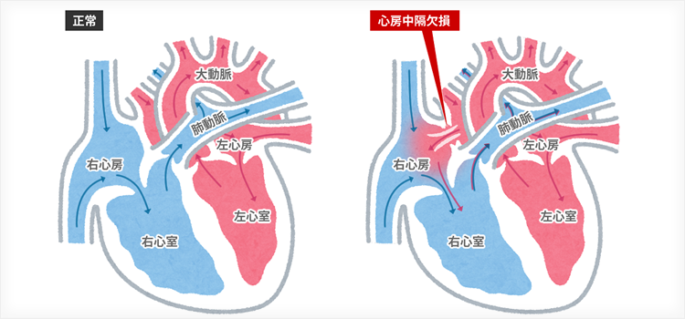 女性に多くみられる心臓・血管病変