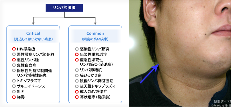 リンパ節腫大