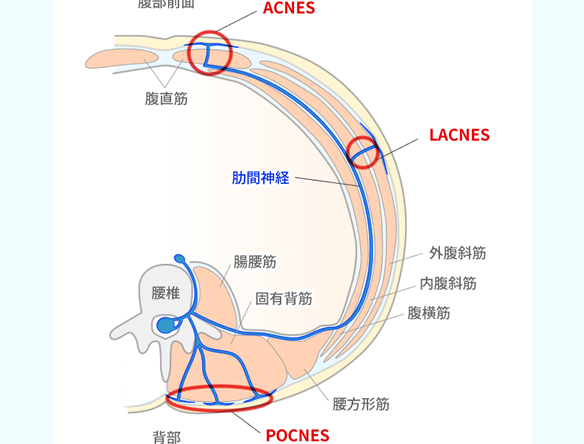 前皮神経絞扼症候群（ACNES）