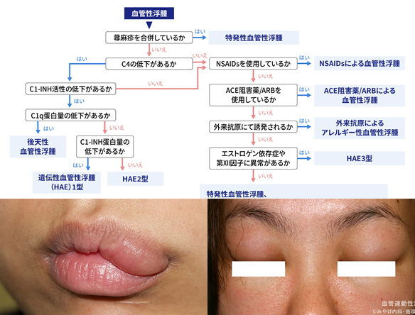 主に顔面に限局する浮腫