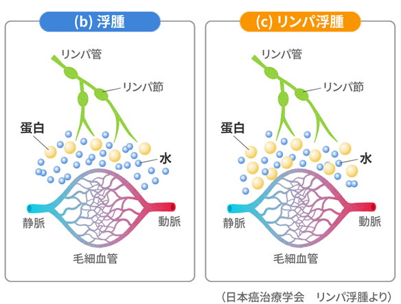 主に下肢に限局する浮腫