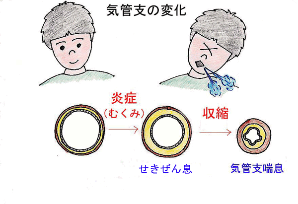 気管支の変化