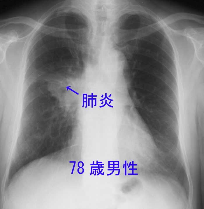 細菌性肺炎のレントゲン写真（78歳男性）