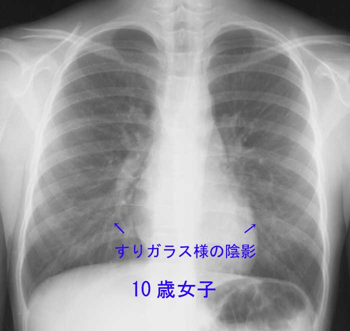 気管支炎・肺炎