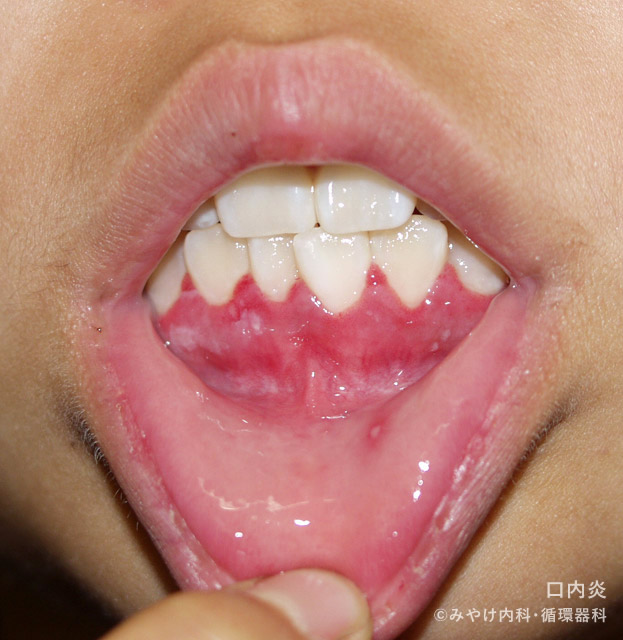 ヘルペス性歯肉口内炎-写真05