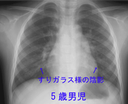 マイコプラズマ感染症 肺炎 診察室でよくみる子どもの病気 みやけ内科 循環器科