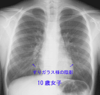 よく見られる子どもの病気：マイコプラズマ感染症・肺炎