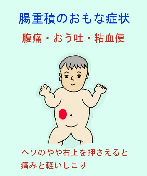 腸重積のおもな症状