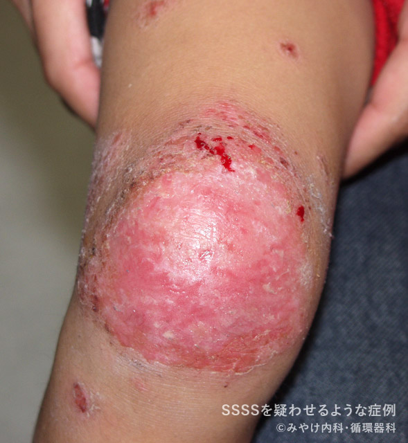 ブドウ球菌性熱傷様皮膚症候群（SSSS）
