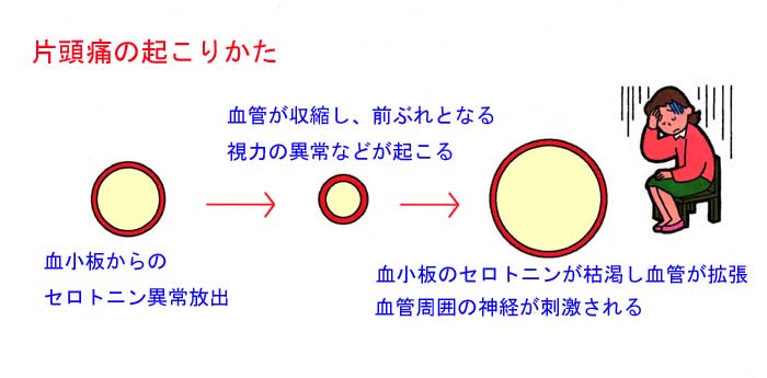 片頭痛の起こりかた