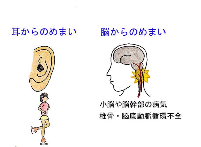 ぐるぐるめまい（回転性めまい）