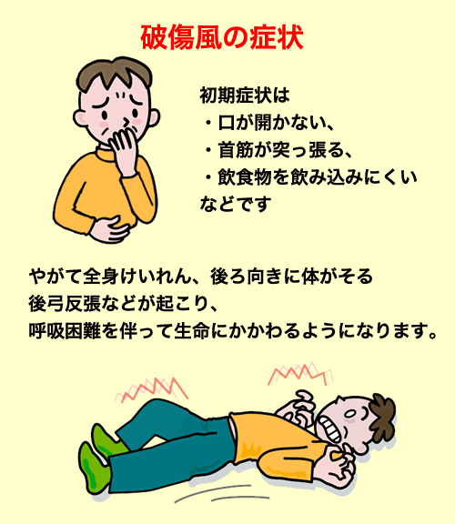 破傷風の症状