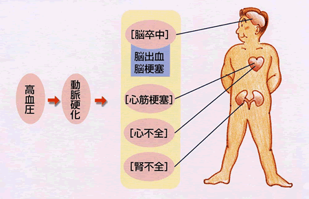 高血圧は心臓病や脳卒中の危険性が高い