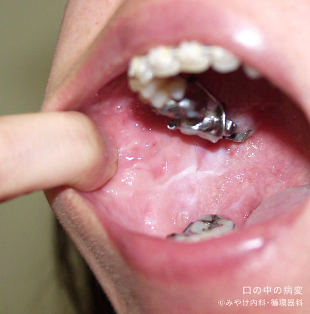 口の中の病変-写真4