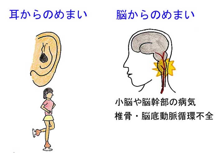 耳からのめまい、脳からのめまい