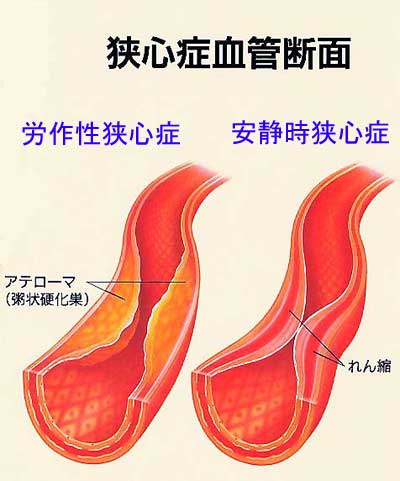 狭心症の血管断面