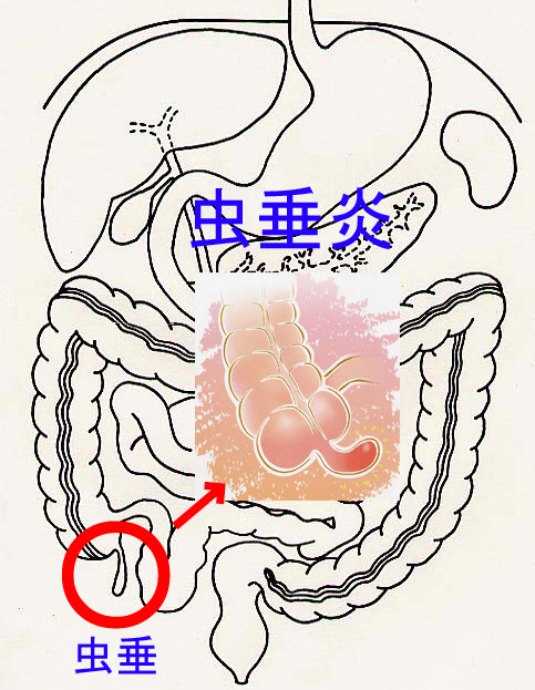 急性 虫垂炎 で み られる の は どれ か