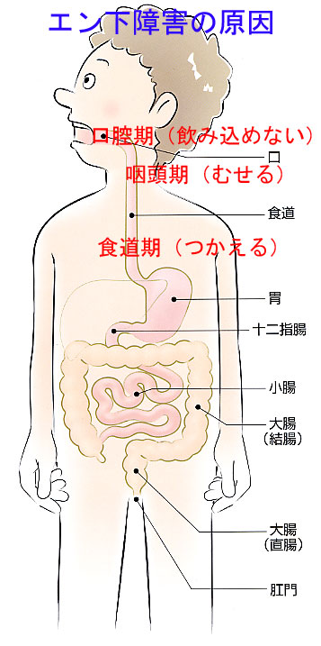 嚥下障害の原因