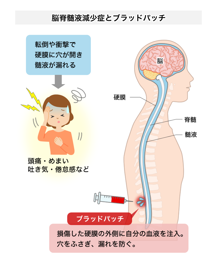 脳脊髄液減少症 診察室でよくみる大人の病気 みやけ内科 循環器科